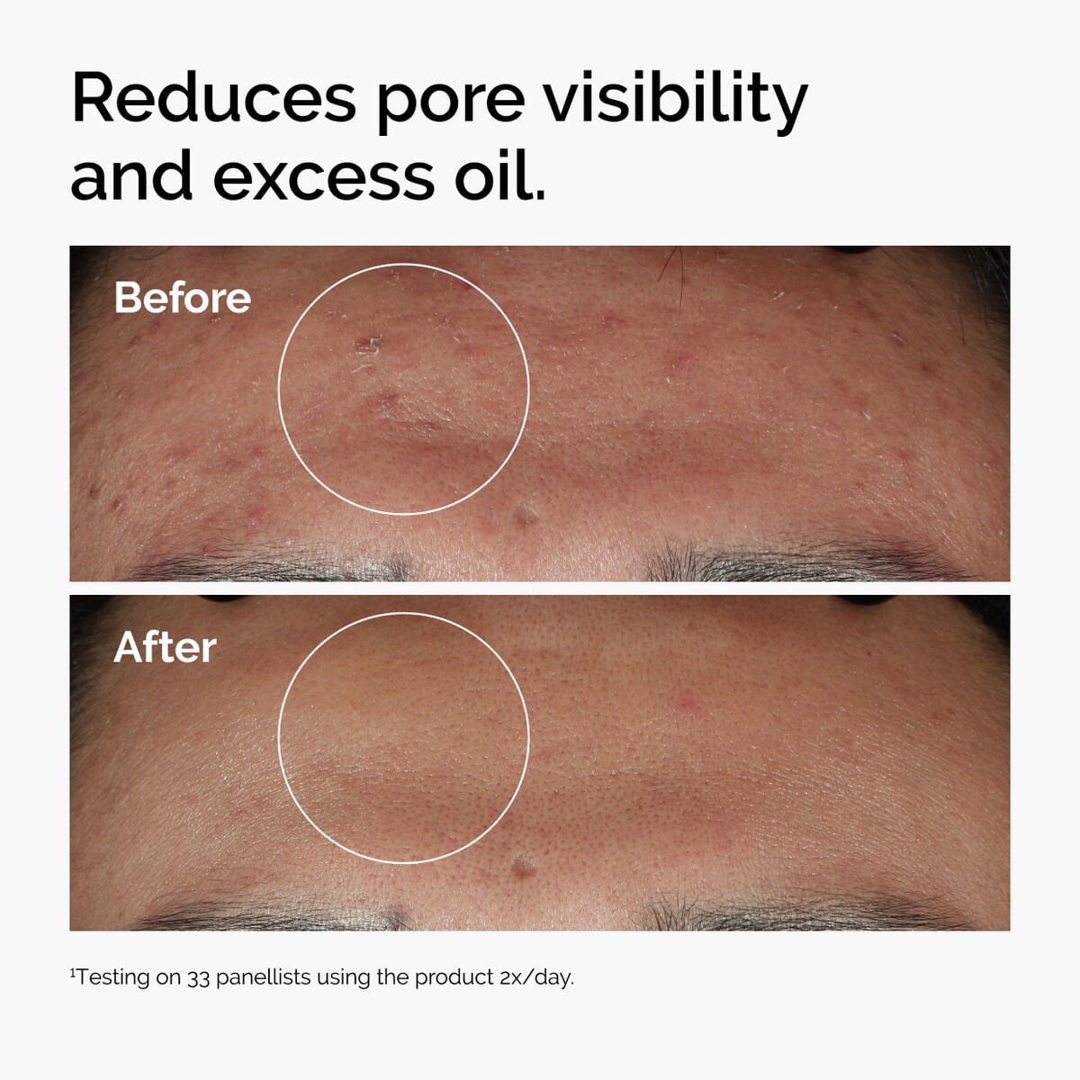 niacinamide-10-zinc-1-n0 ord-niacinamide-zinc-blemish-serum-before-after-pores.jpg